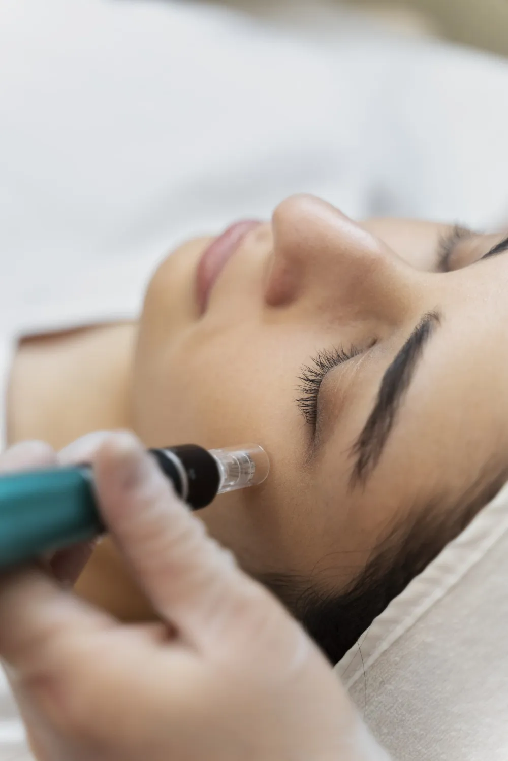 Microneedling-Behandlung im Gesicht